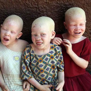 Türk kozmetik sektöründen Tanzanya'daki albinolara güneş kremi hibesi