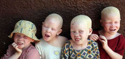 Türk kozmetik sektöründen Tanzanya'daki albinolara güneş kremi hibesi