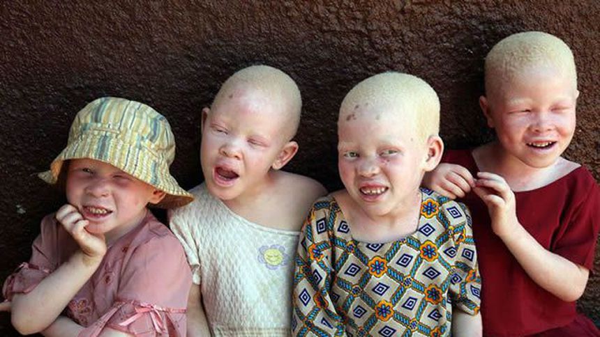 Türk kozmetik sektöründen Tanzanya'daki albinolara güneş kremi hibesi